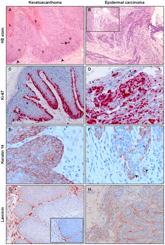 Tumor histology.