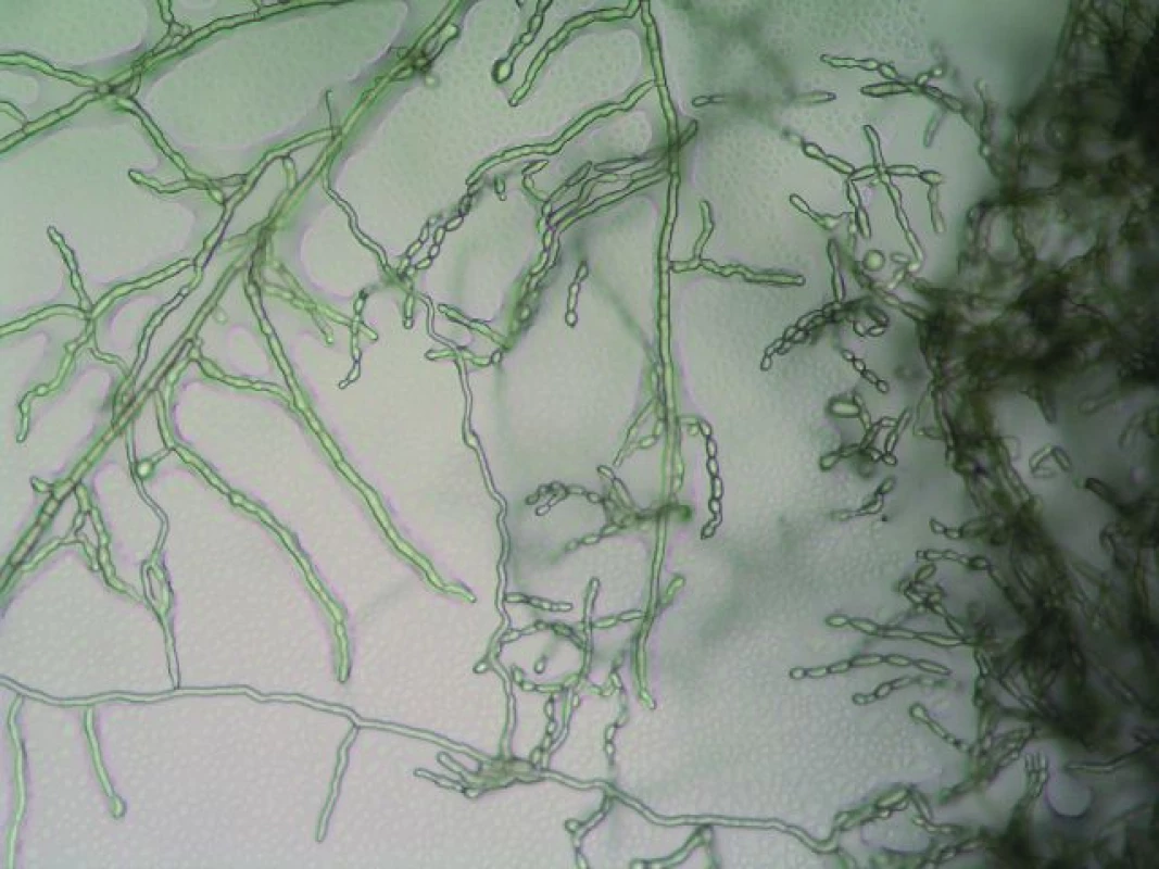 Cladophialophora bantiana – nativní preparát, zvětšení 10 × 20.
Fig. 2. Cladophialophora bantiana – the native preparation, magnification 10 × 20.