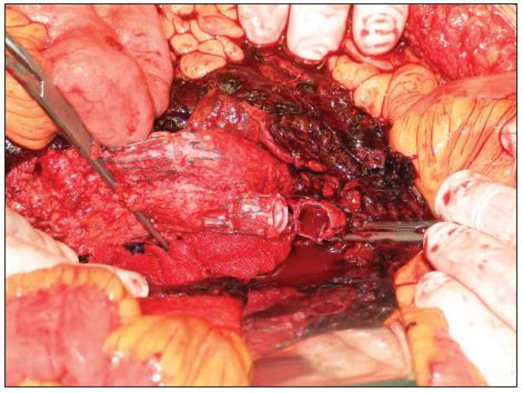 Peroperační nález rozpojeného těla stentgraftu a pravého ilického raménka
Fig. 5. Aperoperative finding of discontinued body and right iliac branch of stentgraft