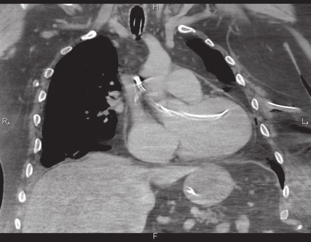 Drén procházející hrudní stěnou do levé komory a až do vzestupné aorty
Fig. 3: Drain passing through the chest wall into the left ventricle and up to the ascending aorta