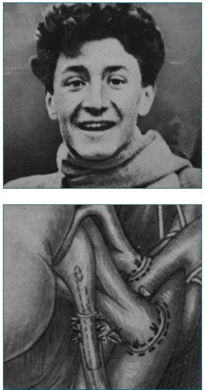 Transplantovaný mladík a skica napojení ledviny mladého Francouze (převzato z publikace Küss René, Bourget Pierre: An Illustrated History of Organ Transplantation, The Great Adventure of the Century, vydané roku 1992 Laboratoires Sandoz v Rueil-Malmaison ve Francii).