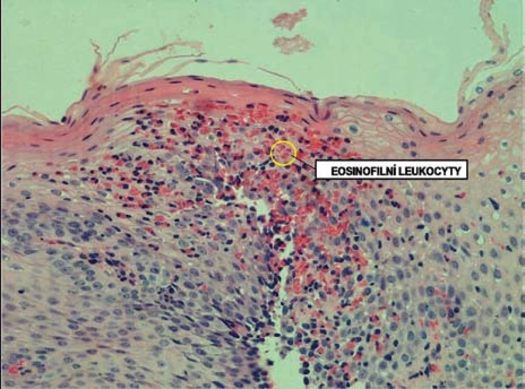 Histologický obraz infiltrace sliznice jícnu eozinofily.
Fig. 6. Histological image of esophageal infiltration by eosinophils.