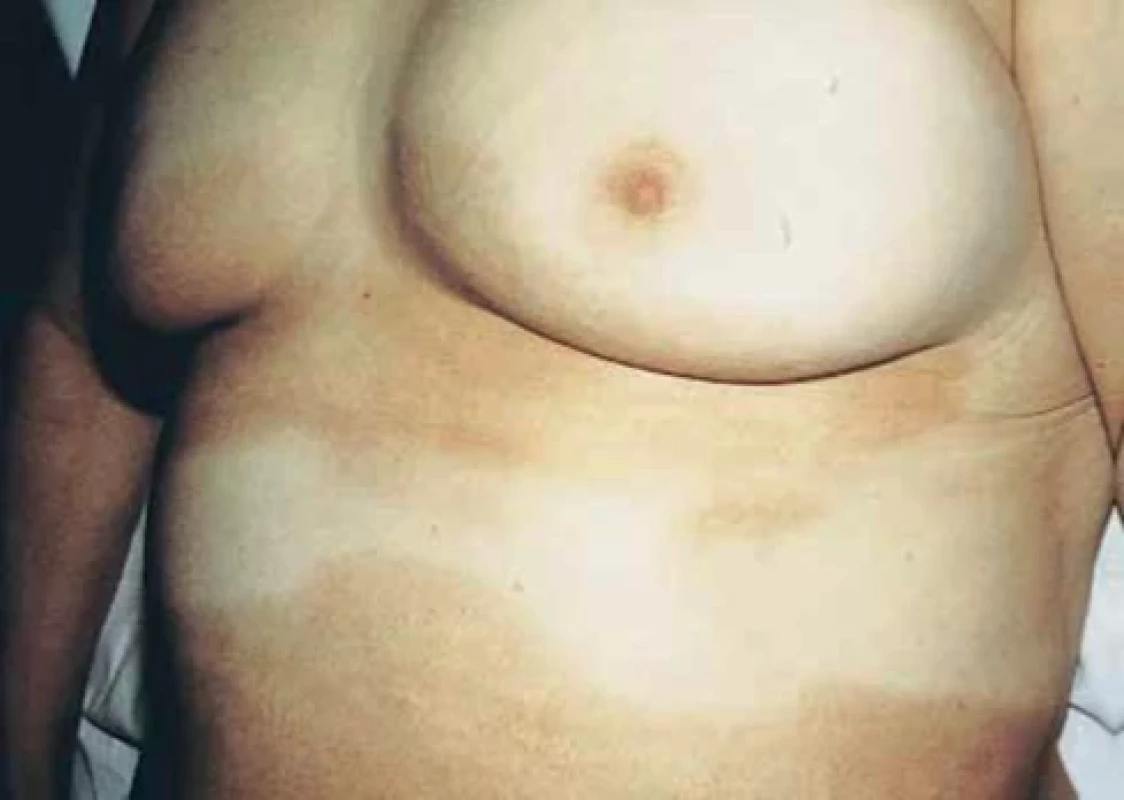 Morfea profunda (převzato z 6)