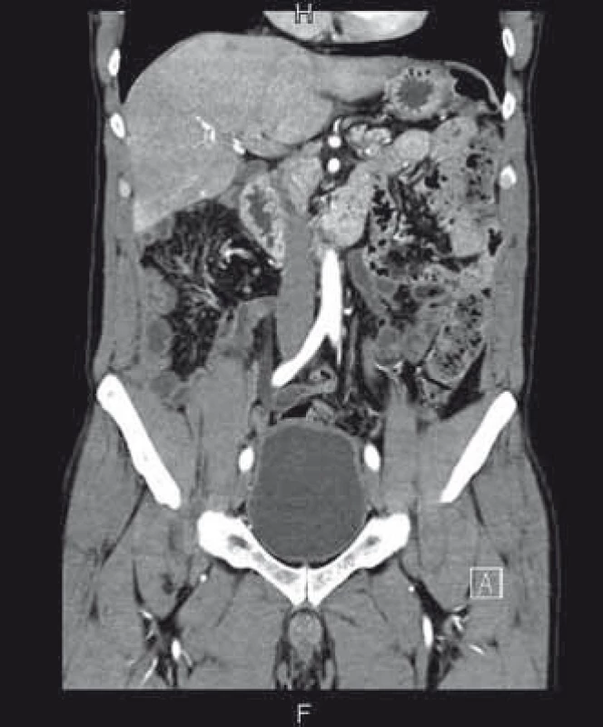 CT břicha 6 měsíců po léčbě, kde je patrná prakticky kompletní regrese.
Fig. 3. Abdominal CT 6 months after treatment with almost complete regression.
