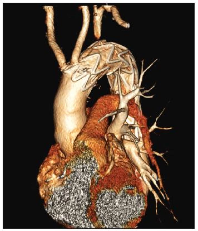 54-ročný muž s aneuryzmatickou dilatáciou anomálne odstupujúcej arteria subelavia dextra (arteria lusoria).
Stav po implantácii hrudného stentgraftu do oblasti aortálneho oblúka a dodilatovaní stentgraftu CT angiografia aortálneho oblúka.
Fig. 6. A 54-year old male with aneurysmal dilatation of an abnormal arteria subclavia dextra (arteria lusoria). Following thoracic stentgraft implantation into the aortic arch region and completion of the stentgraft dilation. CT angiography of the aortic arch. 