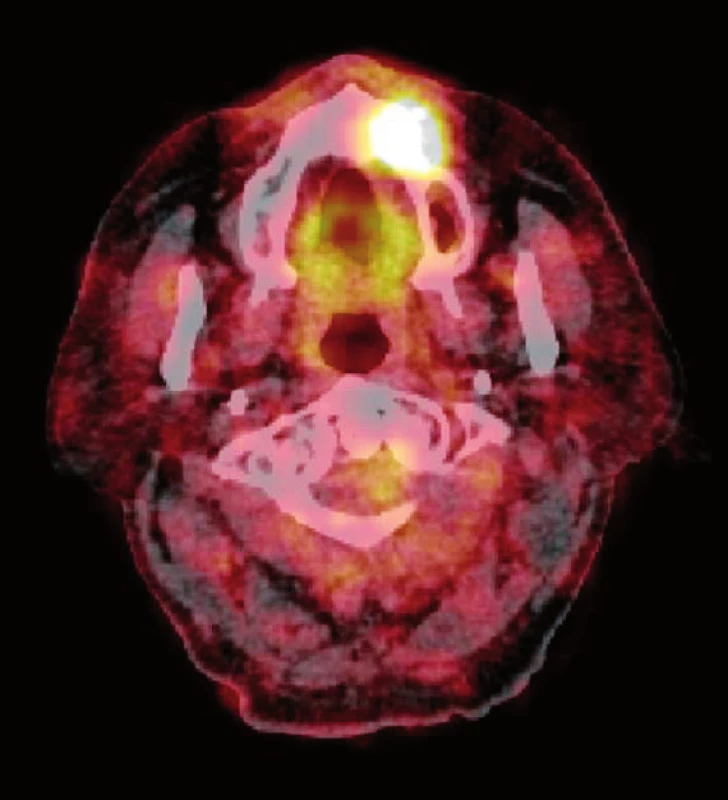 Zvýšené vychytávání radiofarmaka (<sup>18</sup>F-FDG) v oblasti osteonekrózy maxilly při PET/CT vyšetření u pacienta z obrázku 3 (zdroj: Klinika zobrazovacích metod LF UK a FN Plzeň, přednosta: doc. MUDr. Boris Kreuzberg, CSc.).
Fig. 6. The increased uptake of the radiopharmaceutical (<sup>18</sup>F-FDG) in the area of maxillary osteonecrosis detected by PET/CT scans in patient demonstrated in Figure 3 (source: Department of Imaging Methods, University Hospital and Faculty of Medicine in Pilsen, Charles University in Prague, Head of Department: doc. MUDr. Boris Kreuzberg, CSc.).