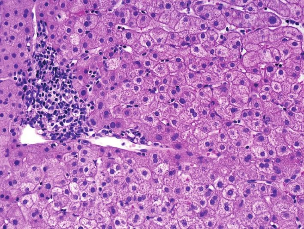 Chronická allograft hepatitida se zánětem na periferii port. pole u příjemce, který podstoupil transplantaci kvůli epiteloidnímu hemangioendoteliomu a nemá „de novo“ virovou hepatitidu (HE, objektiv 20x).