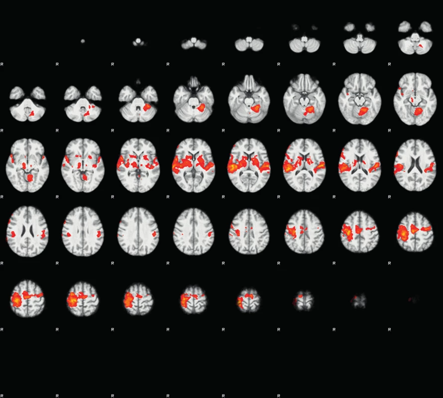 Průměrné skupinové aktivace ve fMRI mozku při pohybu levým zápěstím, před operací krční páteře (Pozadí − zprůměrované T1-vážené obrazy s vysokým rozlišením (sekvence >MPRAGE); popředí − statistické Z mapy − červená (minimum), žlutá (maximum).
Fig. 1: Analysis of mean group effects in brain fMRI during movement of left wrists, before surgery (Background - T1-weighted scans with high resolution (sequences >MPRAGE). Picture - statistical Z-maps -red (minimum), yellow (maximum).
