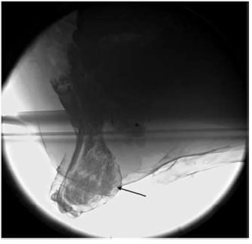 Velký externí prolaps s enterokélou herniující rovněž zevně.
Fig. 4. A huge overting rectal prolaps with enterocele protruding outside.