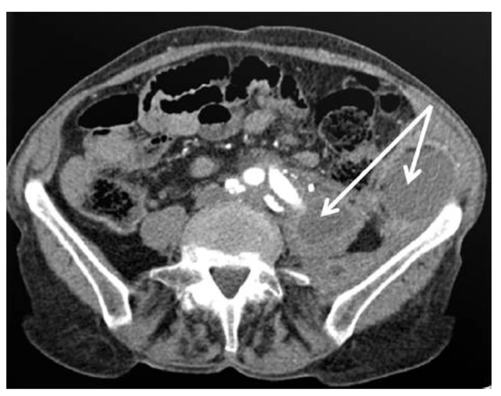 Snímek infekce aortobifemorální protézy (šipky ukazují tekutiny kolem levého raménka protézy)
Fig. 1: Aortobifemoral graft infection (peri-graft fluid collection marked by arrows)