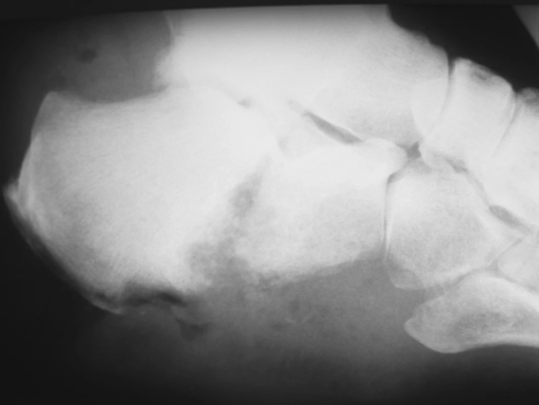 Patologická fraktura patní kosti u pacienta s osteomyelitis calcanei a defektem měkkých tkání
Fig. 3. Pathological fracture of the heel bone in a patient with osteomyelitis calcanei and soft tissue defects
