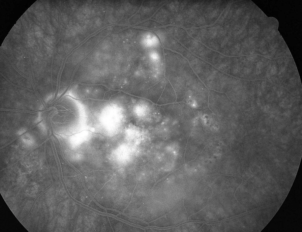 Pac. č. 5: Fluoresceínová angiografia ĽO: početné body presakovania pod rozsiahlou ablaciou neuroepitelu retiny. Temporálne od TZN stopy po ALK