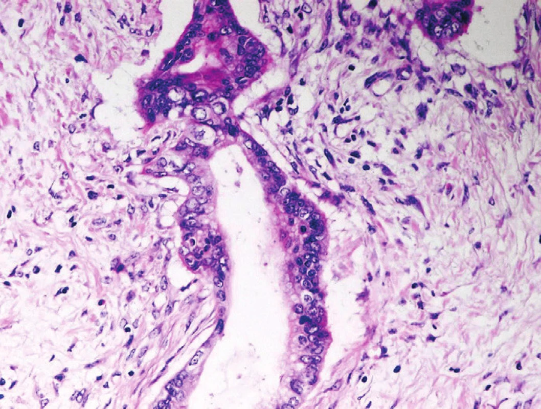 Pankreatický duktální adenokarcinom (PDA). Celulární kondenzace stromatu kolem nepravidelné angulární neoplastické duktální formace PDA. Cytologicky vyjádřené znaky malignity. Barveno hematoxylinem eozinem (zvětšení 200x).