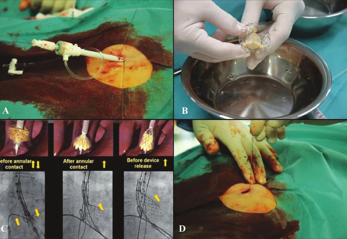 Technika implantace
Fig. 1. Technique of implantation