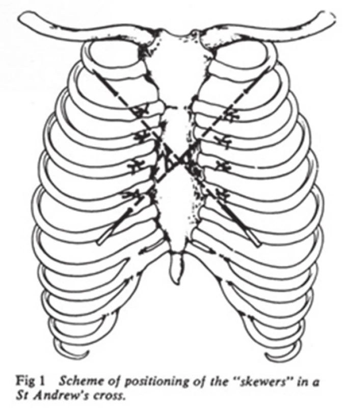 Technika podle Guernelliho
Fig. 7: Guernelli technique