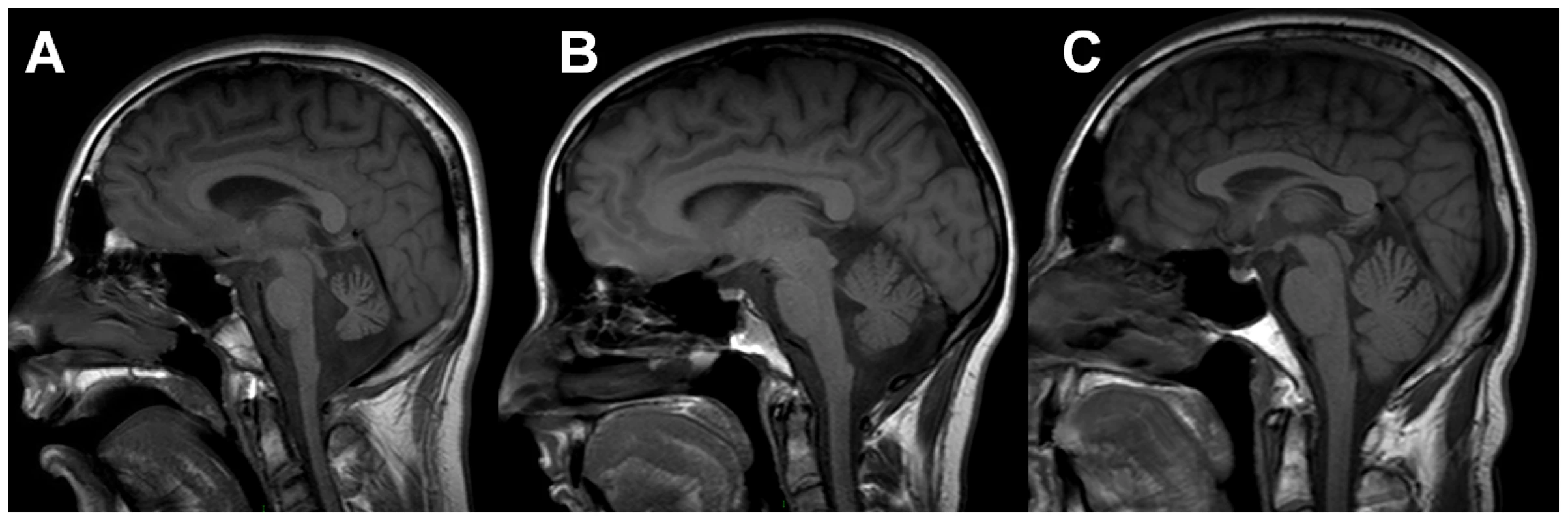Neuroimaging of family members.
