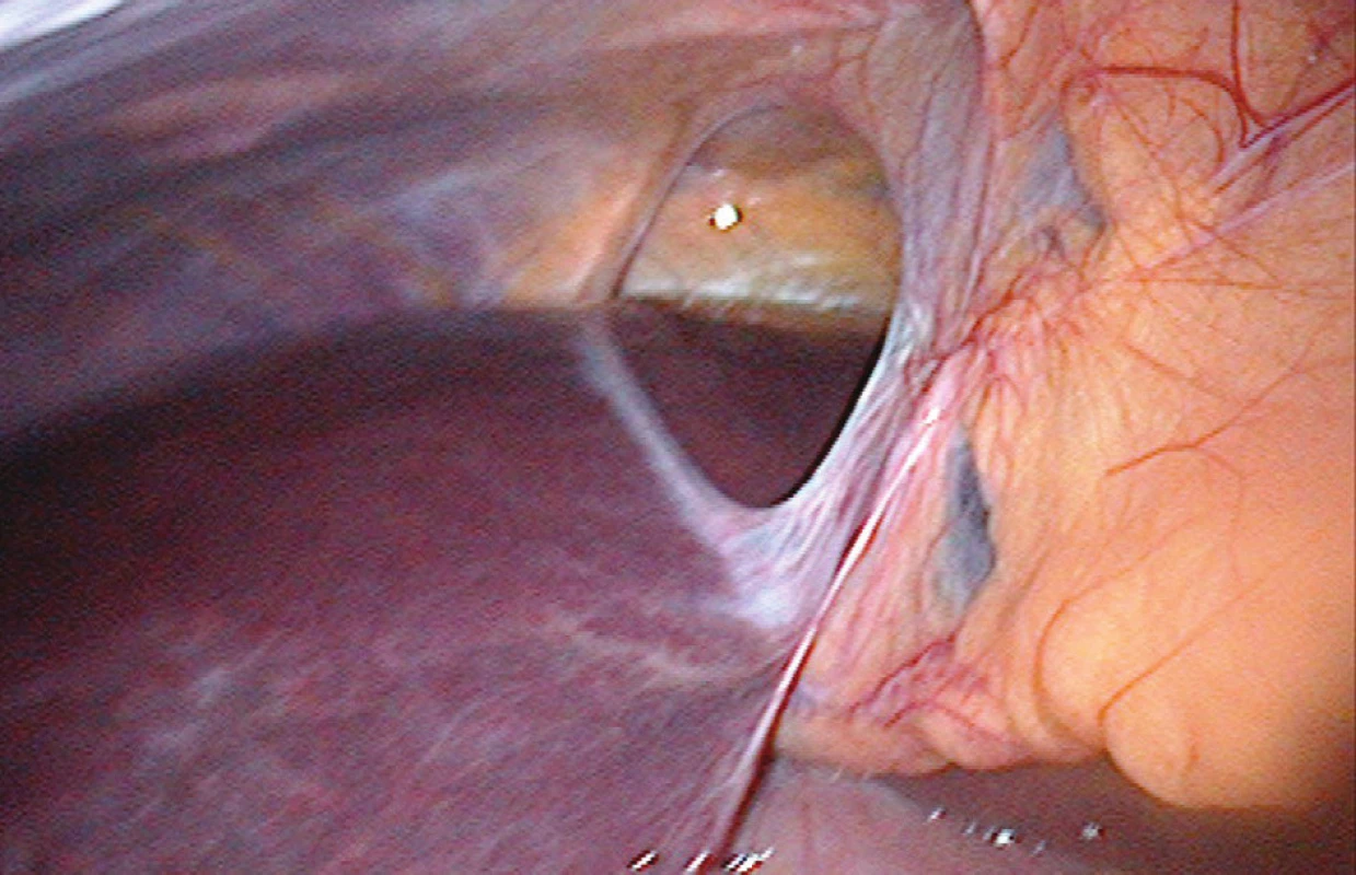 Defekt v ligamentum falciforme hepatis (peroperační snímek)
Fig. 2: The falciform ligament defect (perioperative photo)