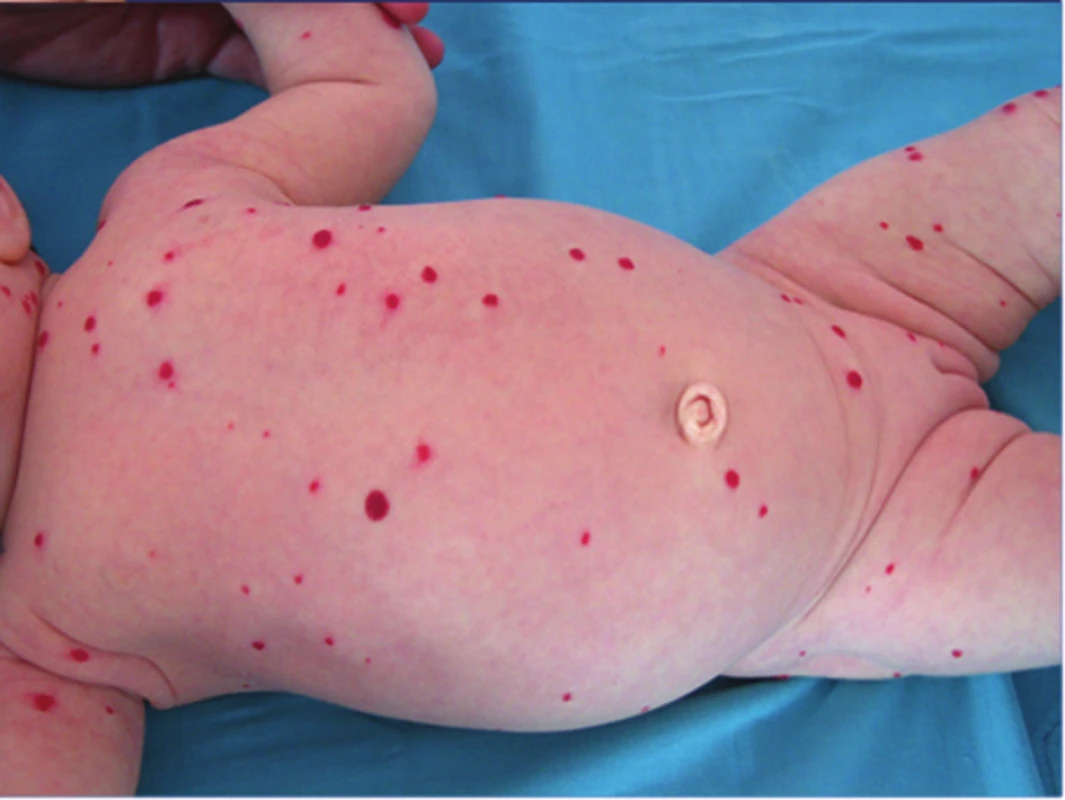 Difuzní neonatální hemangiomatóza, IH se vyskytují i v játrech
