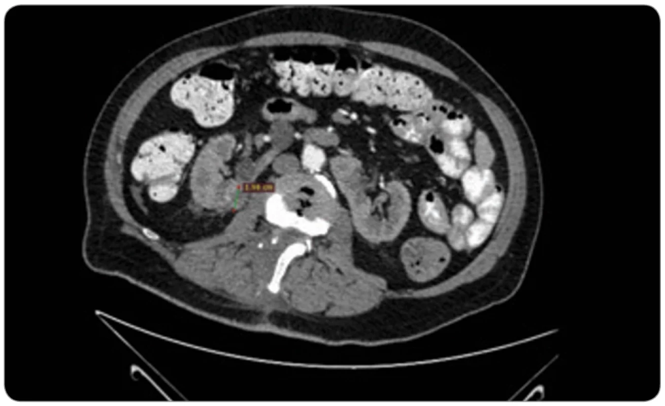 CT axial scan (arterial phase post IV contrast medium injection) showing partly  exophytic lesion in the posterior side of the right moiety of the horseshoe kidney.