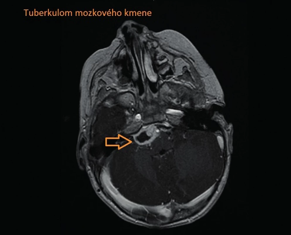 Tuberkulom mozkového kmene.
Fig. 3. Brain-stem tuberculoma.
