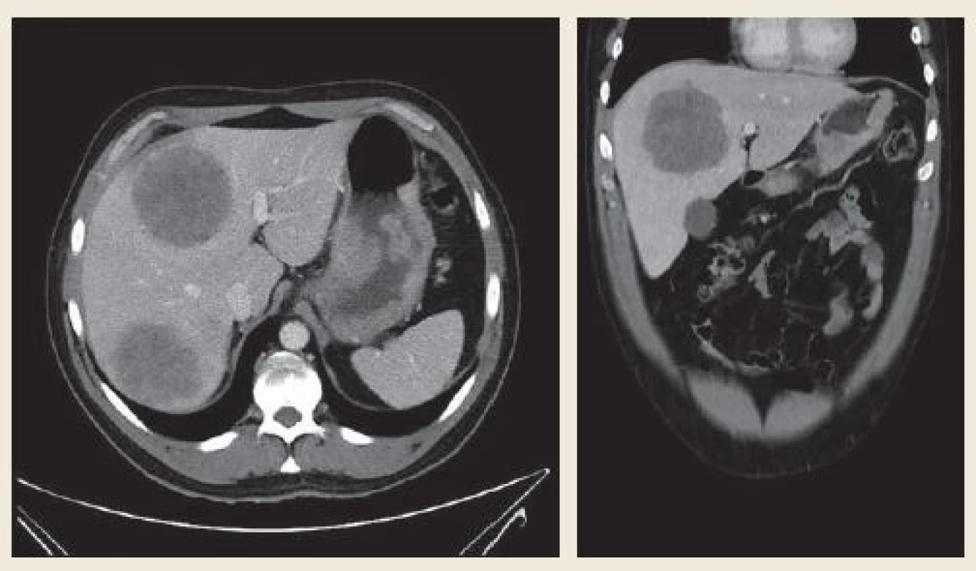 Tumor postihující zadní stěnu žaludku od úrovně kardie téměř po angulus, stěna rozšířená nepravidelně až na 30 mm, výrazná spádová lymfadenopatie – perigastricky zmnožené uzliny 8–17 mm. Vícečetná metastatická ložiska jater veli-kosti 40–85 mm.
Fig. 2. A tumour affecting the posterior wall of the stomach from the level of cardia almost up to the angulus, the wall is irre-gularly extended to up to 30 mm, distinct catchment lymphadenopathy – next to the stomach multiplied nodules of 8–17 mm. Multiple metastatic foci sized 40–85 mm in the liver.