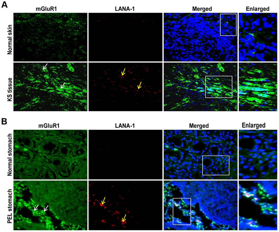 mGluR1 detection in KSHV infected patient samples.