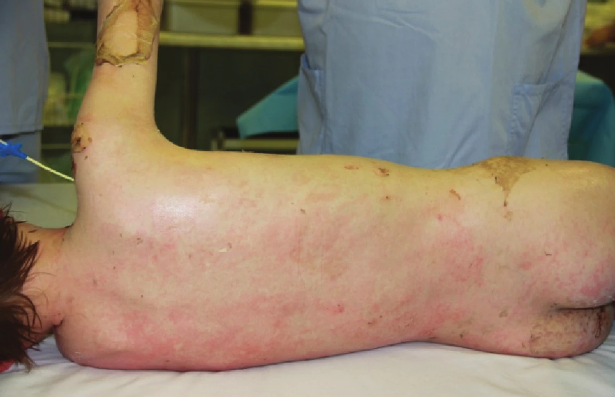 Zhojené plochy na zádech po sejmutí xenotransplantátů
Fig. 4: Healed areas on the back following the removal of xenotransplants
