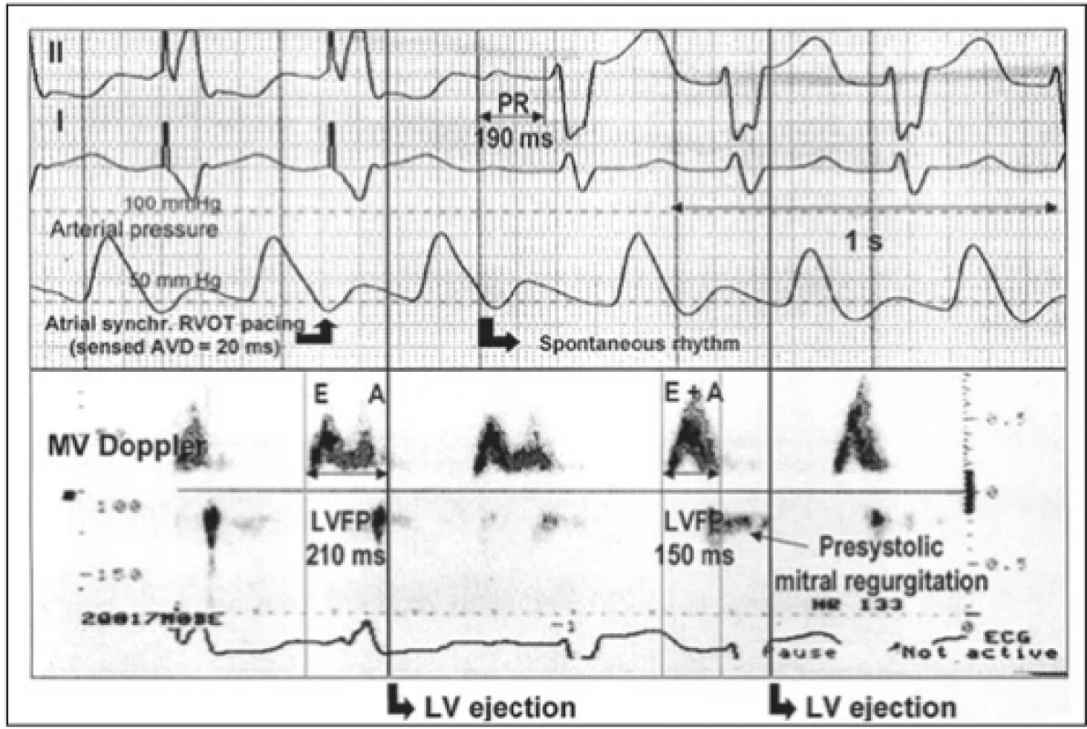  Dokumentace změn úspěšné resynchronizační léčby. V pravé části bez resynchronizace je patrný obraz širokého QRS komplexu na EKG, na dopplerovské křivce tomu odpovídá zkrácené diastolické plnění levé komory s fúzí vlny rychlého diastolického plnění a vlny síňové kontrakce (spojená vlna E + A). Zapojením elektrické synchronizované kontrakce síně a pravé komory (v pravé části) se zkracuje QRS komplex na EKG a prodlužuje se diastolické plnění levé komory ze 150 ms na 210 ms se separací vln rychlého plnění (vlna E) a síňové kontrakce (vlna A).