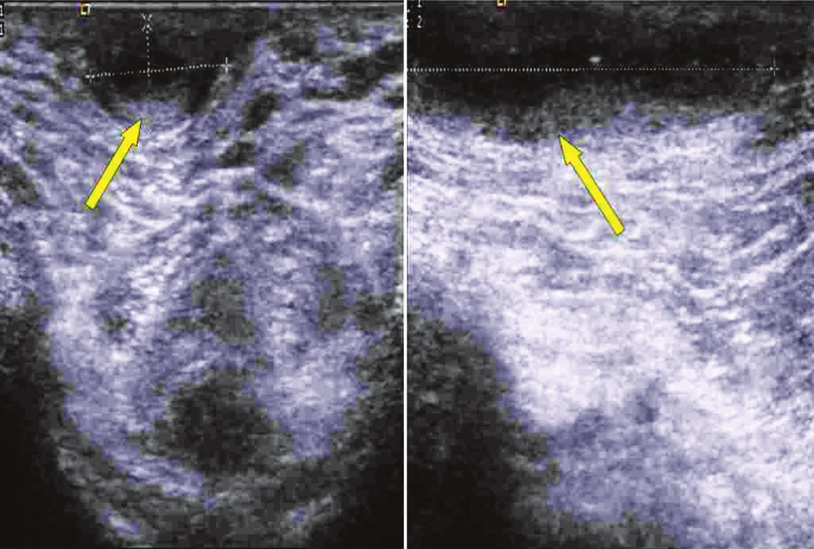 USG perianální krajiny s anální píštělí
Fig. 3. Ultrasound examintion of perianal region with anal fistula