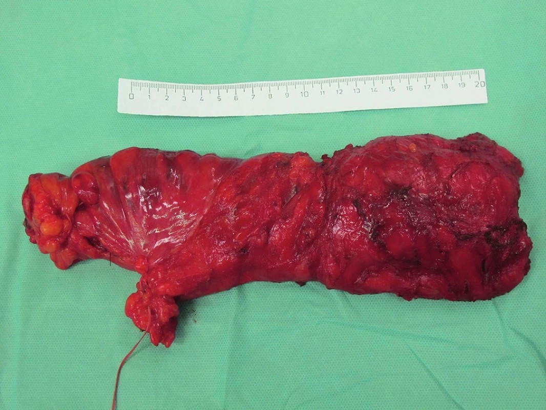 Roboticky asistovaná resekce rekta s kompletní totální mezorektální excizí (TME) – fotografie resekátu
Fig. 2. Robotic assisted low anterior resection for rectal cancer with complete total mesorectal excision (TME) – photography of resected specimen