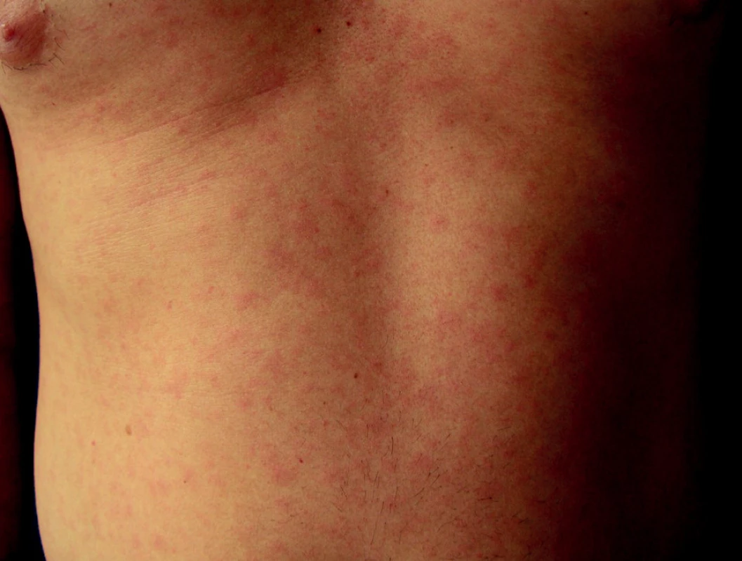 Exantémy syfilis II bývají u HIV+ častější.