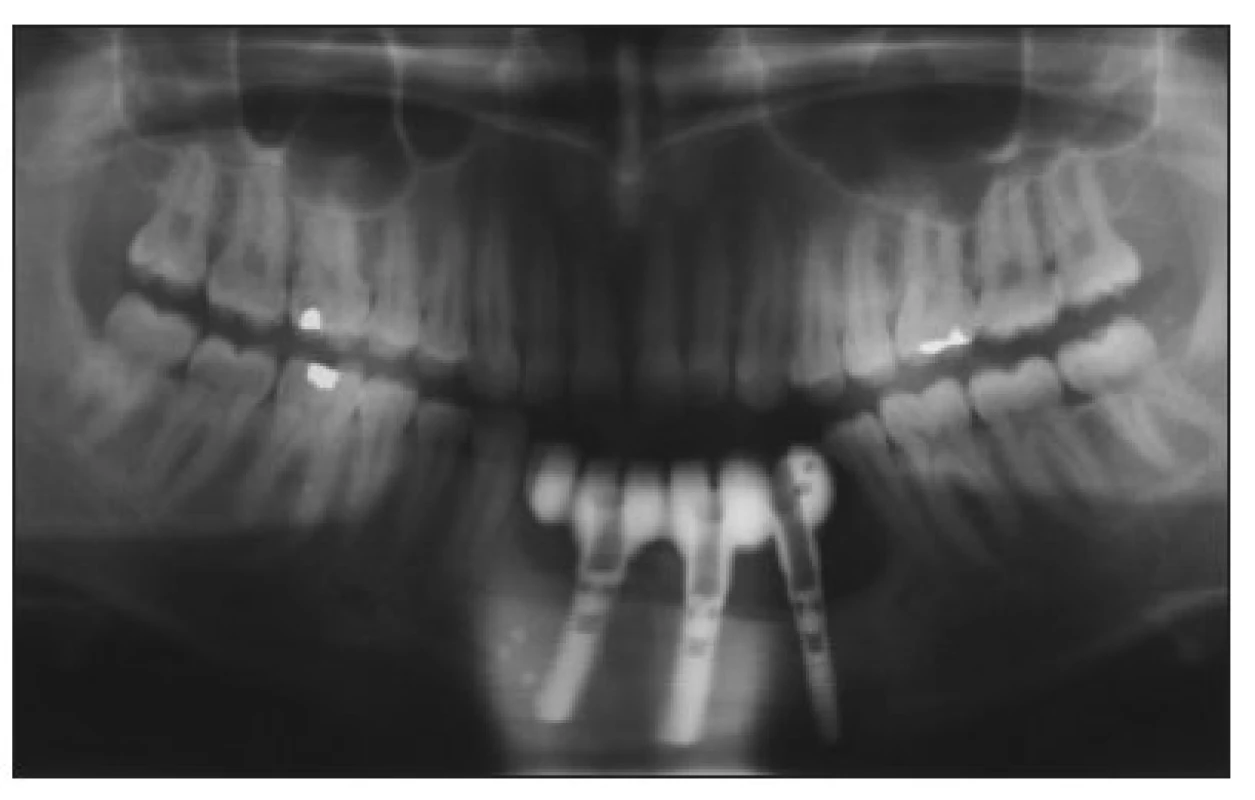 Panoramic radiograph after reconstruction