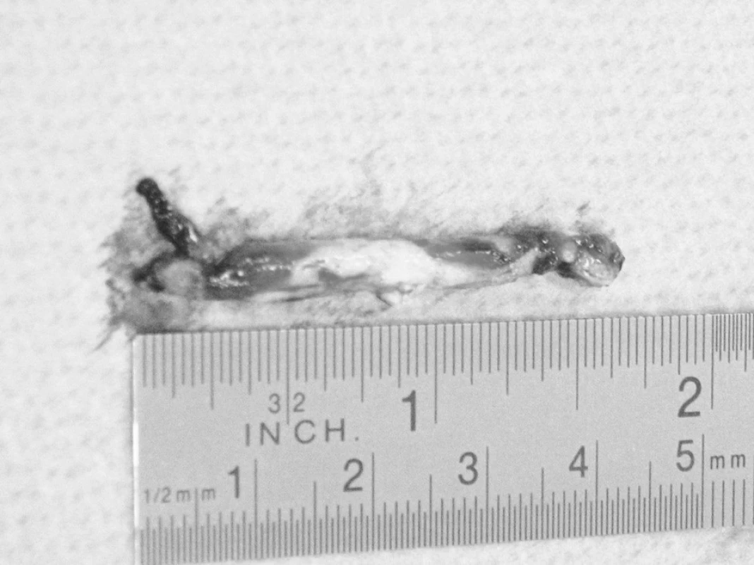 Fotografie vmetku tkáňového lepidla vytaženého z arteriotomie na arteria poplitea
Pic. 2. A picture of the tissue glue embolus, extracted upon arteriotomy of the popliteal artery