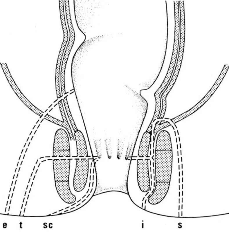 Typy perianálních píštělí
e – extrasfinkterické, t – transsfinkteriské, sc – submukózní, i – intersfinkterické, s – suprasfinktrické
Fig. 2: Types of perianal fistulas
e – extrasphincteral, t – transsphincteric, sc – submucosal, i – intersphincteric, s – suprasphincteral