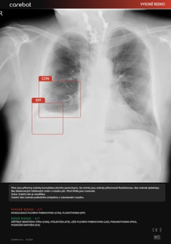 Příklad falešně pozitivní predikce AI: Původní popis verifikovaný seniorním radiologem potvrzuje přítomnost fluidothoraxu vpravo. AI správně identifikovala pleurální výpotek (EFF) jako „vysoké riziko“, avšak nesprávně označila přítomnost konsolidace (CON), pravděpodobně v důsledku změn způsobených sériovou frakturou žeber nebo v rámci pasivní atelektázy vzniklé na podkladě fluidothoraxu. Z radiologů označili EFF jako pozitivní RAD 1 a RAD 3, zatímco RAD 2 tento nález neoznačil. Hodnocení CON bylo u všech radiologů v multi-reader studii v souladu s původním popisem lékaře, který ji označil jako nepřítomnou.