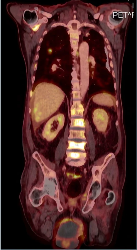 Stagingové PET-CT vyšetření po orchiektomii. Zachycen metastatický orgánový (játra) i kostní (lopatka, páteř) rozsev. Fig. 2. PET-CT as staging examination after orchiectomy. Metastatic organ (liver) and bone (scapula, vertebrae) spread was detected. 