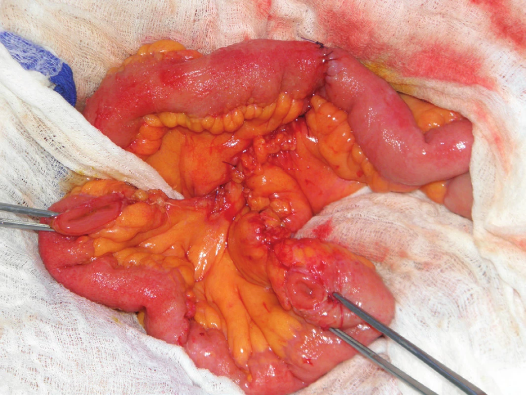 Operační nález: klička ilea exkludovaná z pasáže, ileoileální anastomóza koncem ke konci
Fig. 5: Intraoperative finding: loop of the terminal ileum, excluded from the bowel passage, ileo-ileal anastomosis, constructed end to end