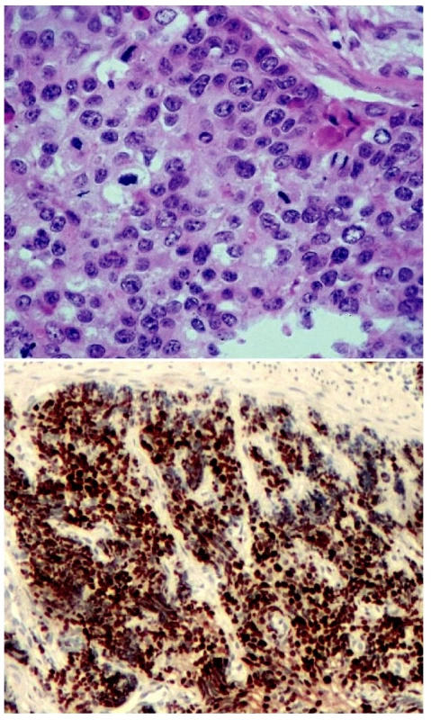 Špatně diferencovaný neuroendokrinní karcinom. Solidně uspořádaný nádor vykazující vysokou mitotickou aktivitu. H&amp;E, 400krát (A), převážná většina nádorových buněk vykazuje jadernou pozitivitu Ki-67, nález odpovídá G3. 100krát (B)