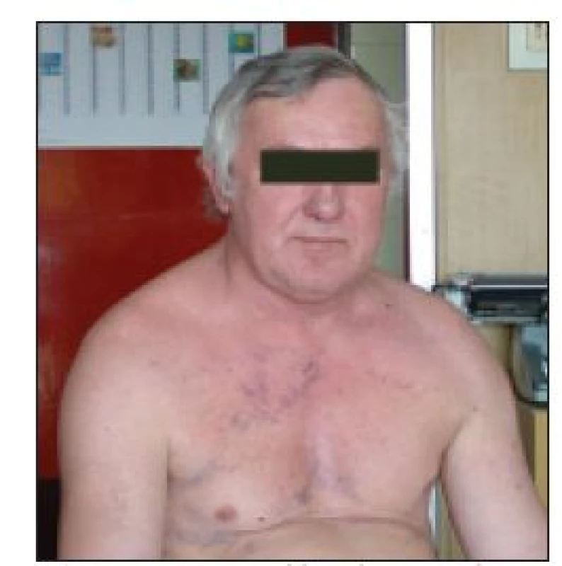 Pacient s klinicky manifestovaným syndromem horní duté žíly.