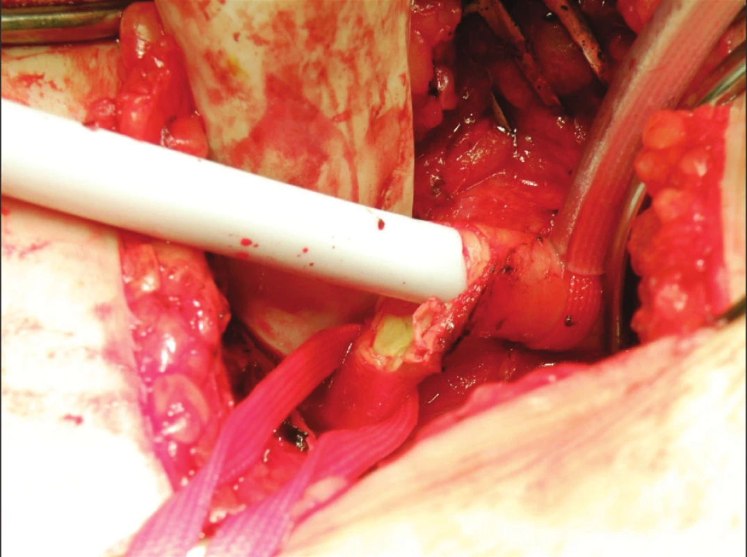 Lacerace stehenní tepny
Fig. 2. Femoral artery laceration