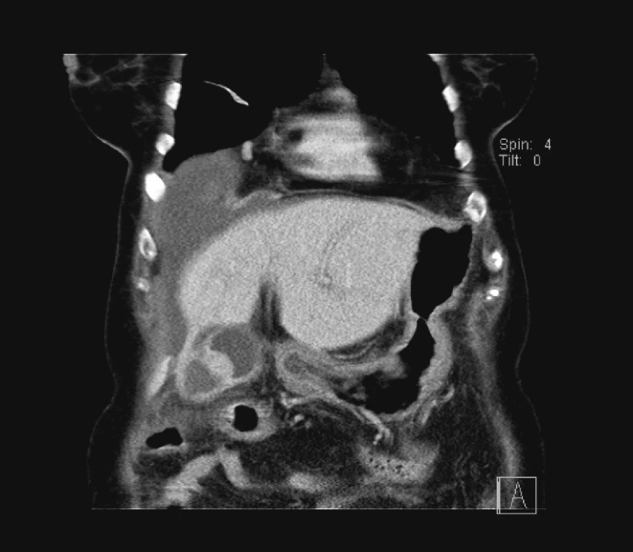 Předoperační CT, koronální řez
Fig. 1. Preoperative CT, coronary section
