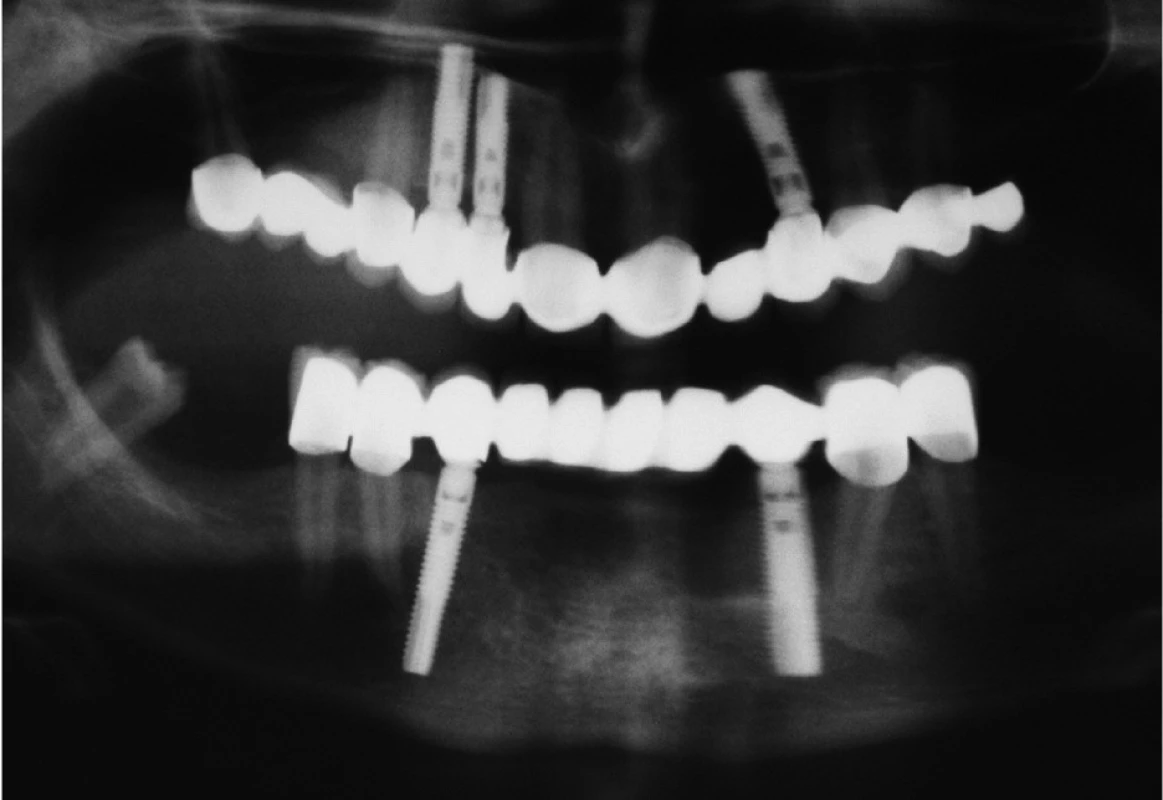 Stav z obrázků 7, 8 a 9 po 2 letech od implantace.