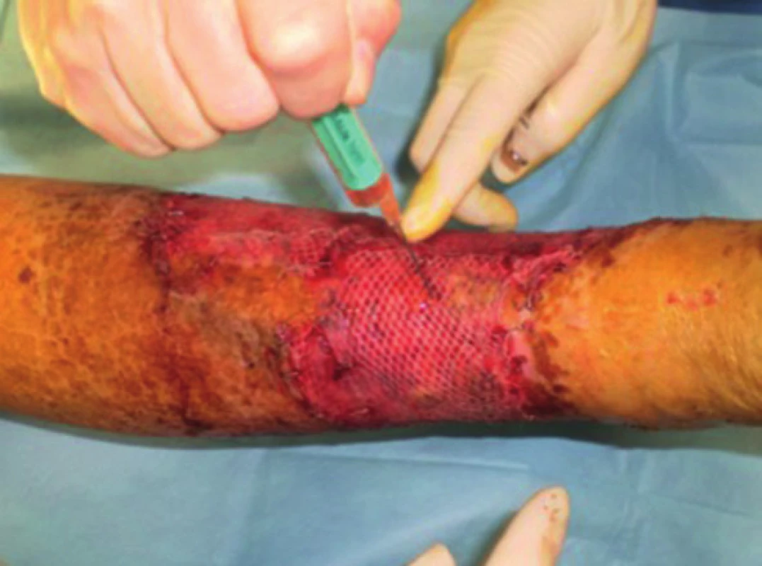 Pacient č. 3 − dermoepidermální autotransplantace s použitím autologní PRP
Fig. 2: Patient No. 3 − split-thickness skin graft and autologous PRP