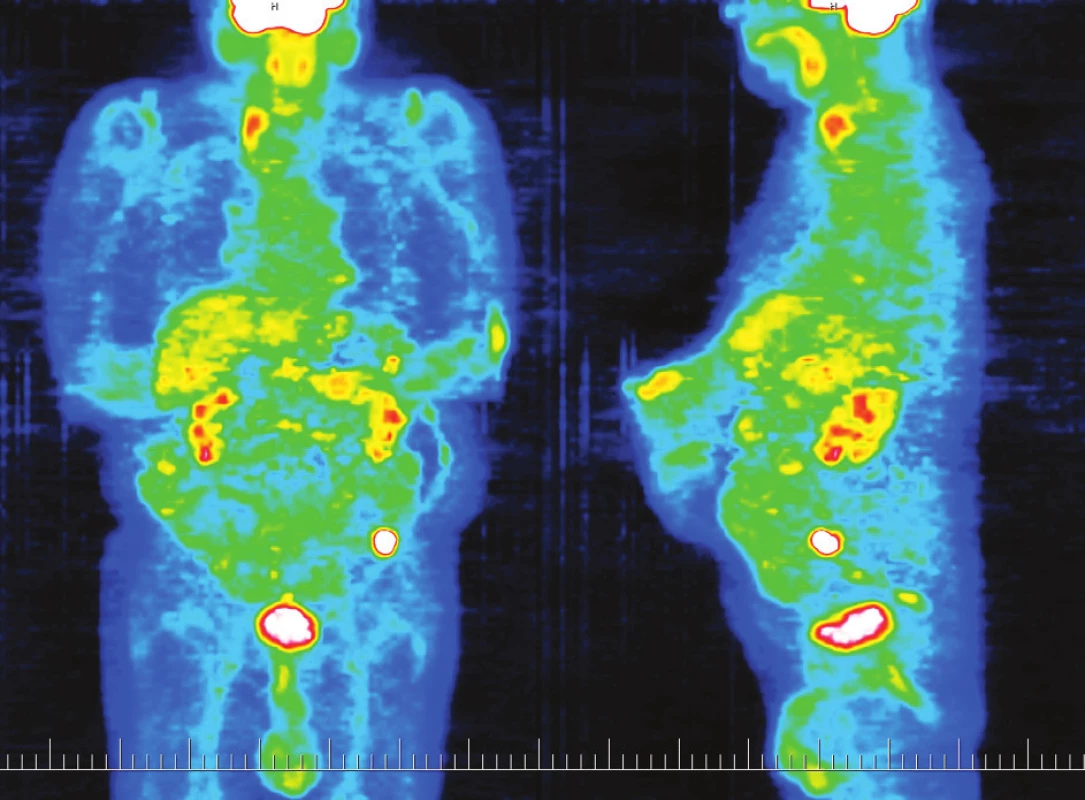PET zobrazující ložisko viabilní nádorové tkáně v levém hypogastriu
Fig. 3. PET depicting a focus of viable tumor tissue in the left hypogastrium