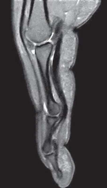 Locked hyperextension in a proximal interphalangeal joint volar plate injury.