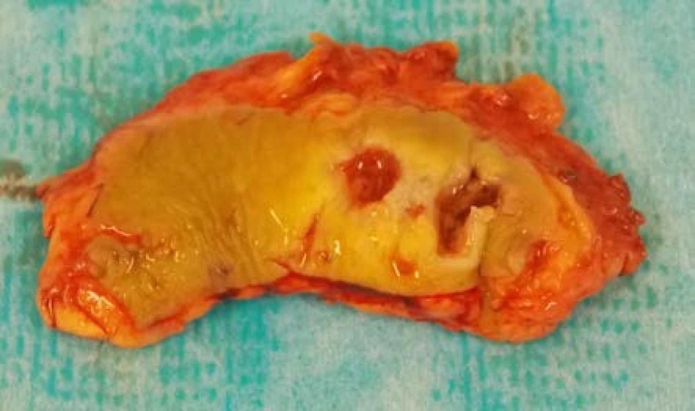 Excidovaná tkáň
Fig. 2. The excised tissue