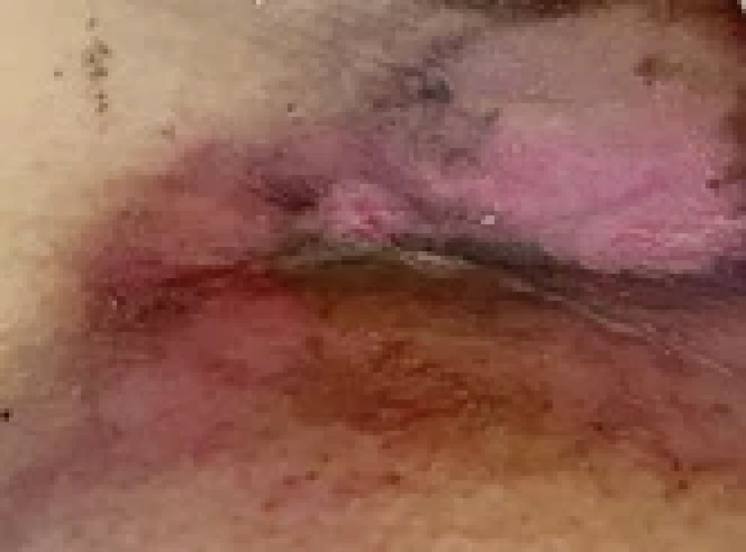 Burn injury after radiotherapy.