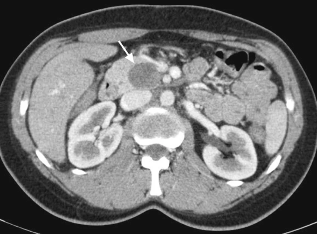 CT vyšetření pankreatu s bolusem kontrastní látky intravenózně v arteriální fázi. V processus uncinatus je patrná dobře ohraničená tumorózní expanze
Pic. 1. CT scan with arterial phase enhancement shows well defined tumorous expansion in the uncinate process of pancreas