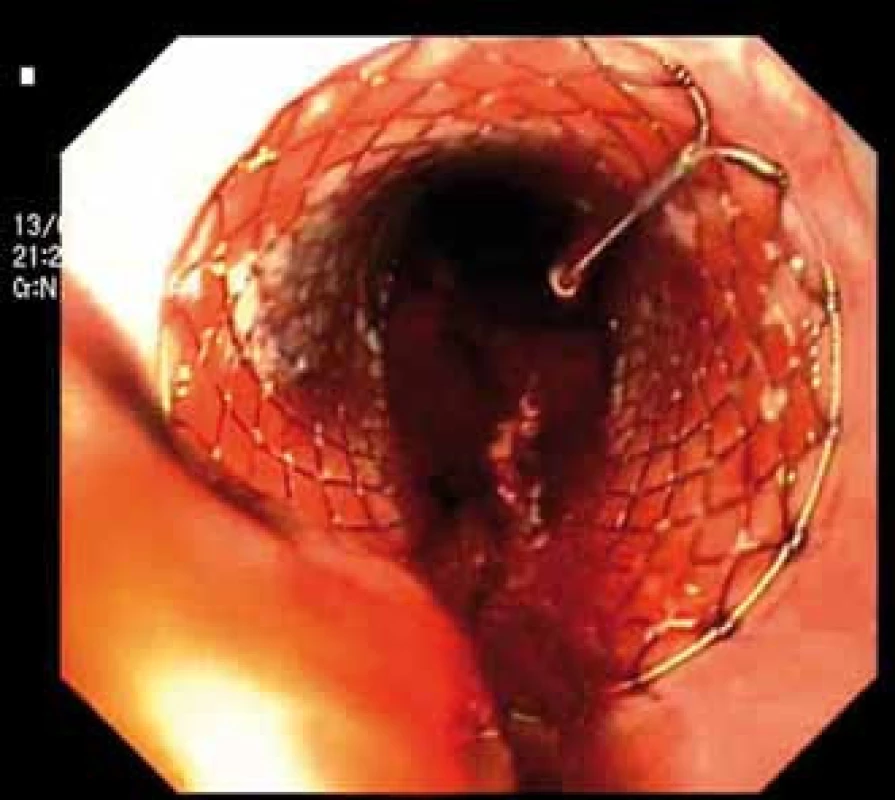 Zavedení Danišova stentu – endoskopický pohled.
Fig. 1. Application of Danis stent – endoscopic image.