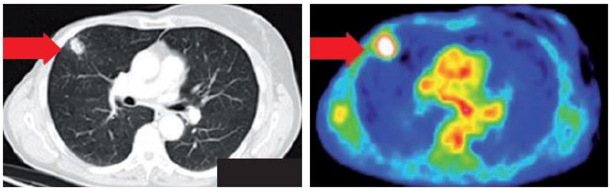 PET/CT ložisko ve středním laloku.